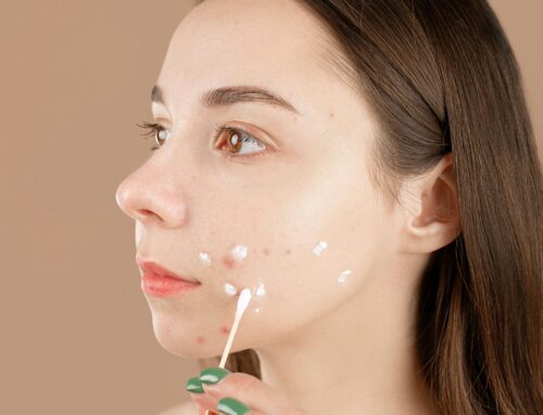 Benzene in Benzoyl Peroxide: Is Your Acne Treatment Safe?